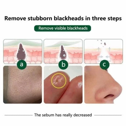 Coffret de produits de soins coréens ANUA Heartleaf Set 77 : Tonique apaisant pour l'acné, lotion quotidienne, mousse nettoyante profonde et huile nettoyante pour le visage